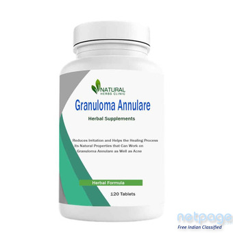 Herbal Supplement for Granuloma Annulare