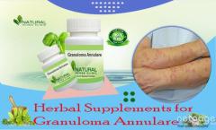 Herbal Remedy for Granuloma Annulare